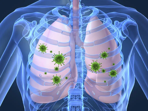 Hantavirus pulmonary syndrome